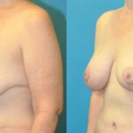 Breast Augmentation & Lift #25 - Before and After