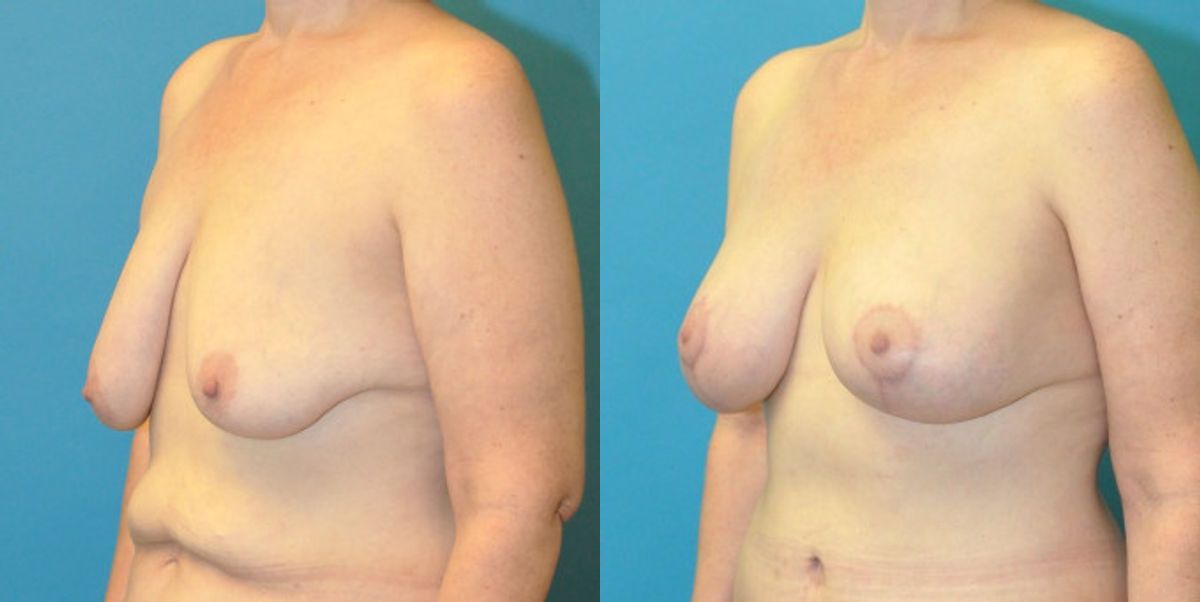 Breast Augmentation & Lift #25 - Before and After