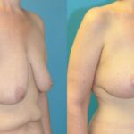 Breast Augmentation & Lift #25 - Before and After