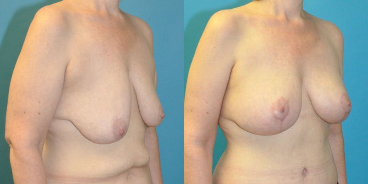 Breast Augmentation & Lift #25 - Before and After