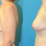 Breast Augmentation & Lift #25 - Before and After