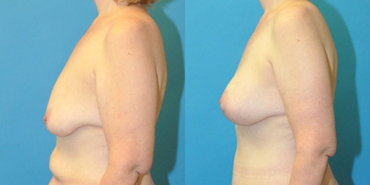 Breast Augmentation & Lift #25 - Before and After