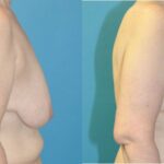 Breast Augmentation & Lift #25 - Before and After