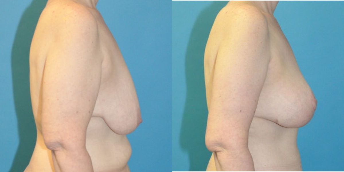 Breast Augmentation & Lift #25 - Before and After