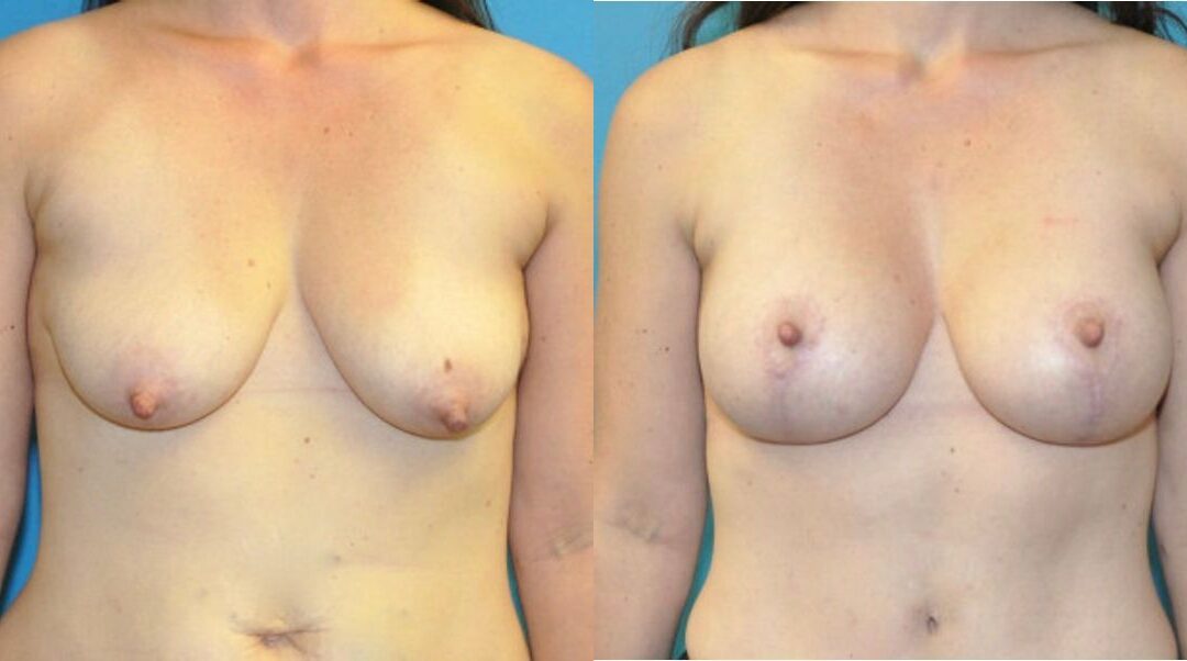 Breast Augmentation & Lift #28
