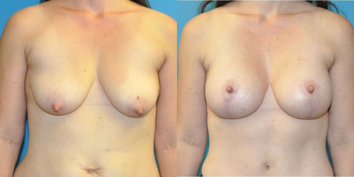 Breast Augmentation & Lift #28 - Before and After