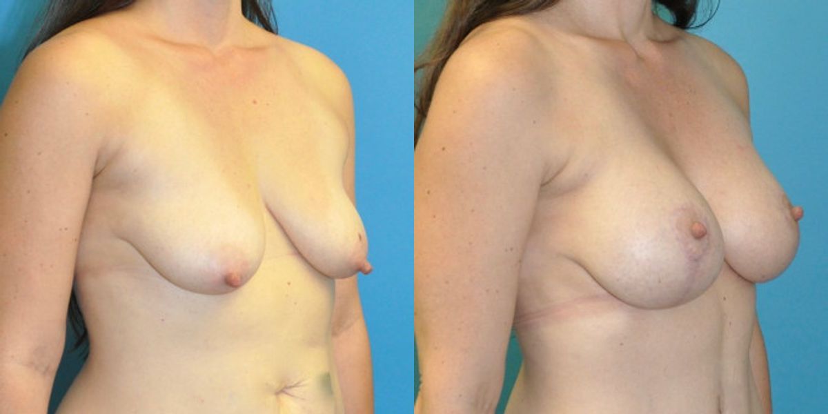 Breast Augmentation & Lift #28 - Before and After