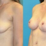 Breast Augmentation & Lift #28 - Before and After