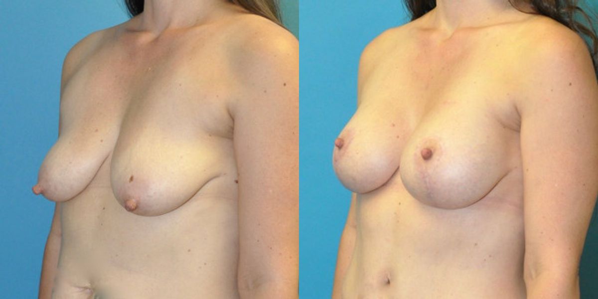 Breast Augmentation & Lift #28 - Before and After