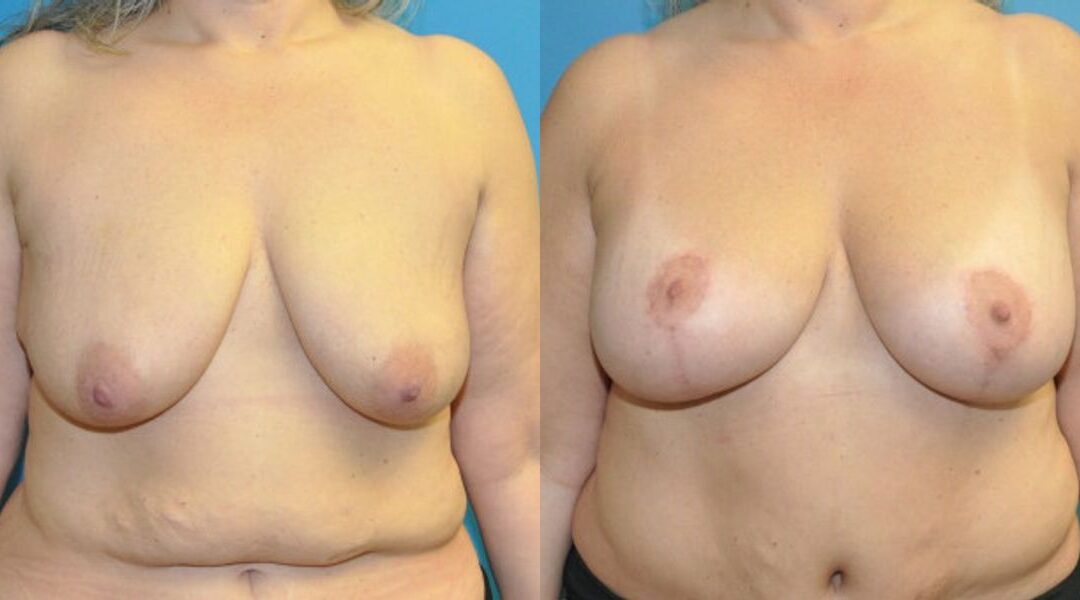 Breast Augmentation & Lift #29