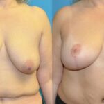 Breast Augmentation & Lift #29 - Before and After