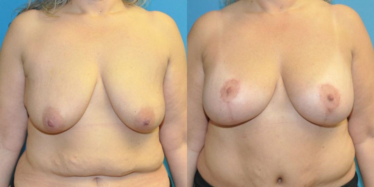 Breast Augmentation & Lift #29 - Before and After