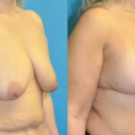 Breast Augmentation & Lift #29 - Before and After