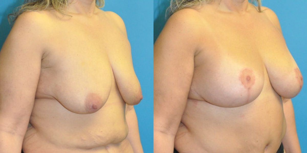 Breast Augmentation & Lift #29 - Before and After