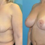 Breast Augmentation & Lift #29 - Before and After