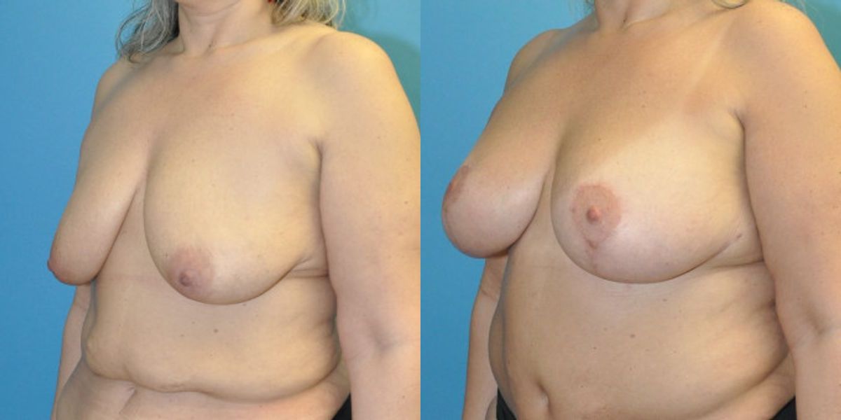 Breast Augmentation & Lift #29 - Before and After