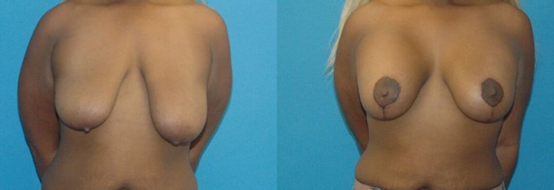 Breast Augmentation & Lift 30