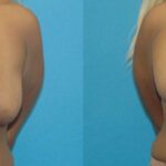 Breast Augmentation & Lift 30 - Before and After