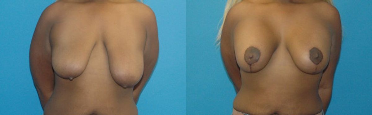 Breast Augmentation & Lift 30 - Before and After