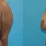 Breast Augmentation & Lift 30 - Before and After