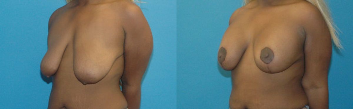 Breast Augmentation & Lift 30 - Before and After