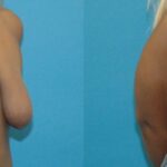 Breast Augmentation & Lift 30 - Before and After