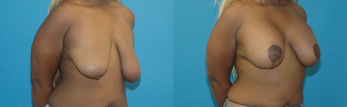 Breast Augmentation & Lift 30 - Before and After