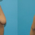 Breast Augmentation & Lift 30 - Before and After