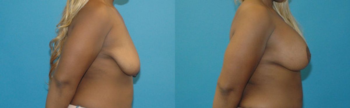 Breast Augmentation & Lift 30 - Before and After
