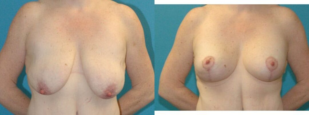 Breast Augmentation & Lift #31