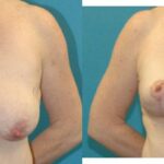 Breast Augmentation & Lift #31 - Before and After