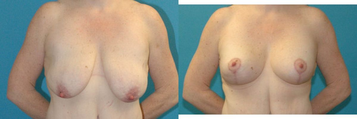 Breast Augmentation & Lift #31 - Before and After