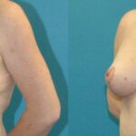 Breast Augmentation & Lift #31 - Before and After