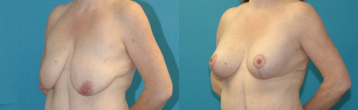 Breast Augmentation & Lift #31 - Before and After