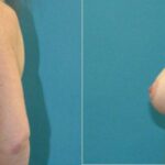 Breast Augmentation & Lift #31 - Before and After