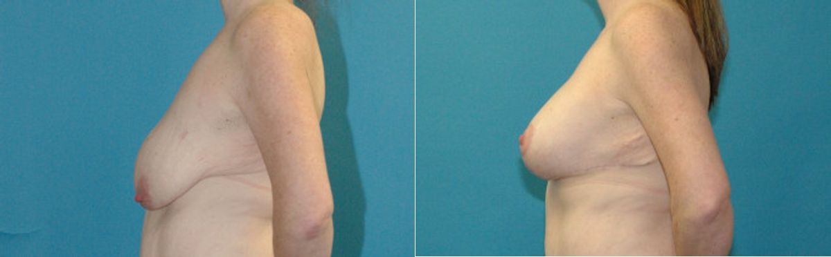 Breast Augmentation & Lift #31 - Before and After