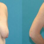 Breast Augmentation & Lift #31 - Before and After