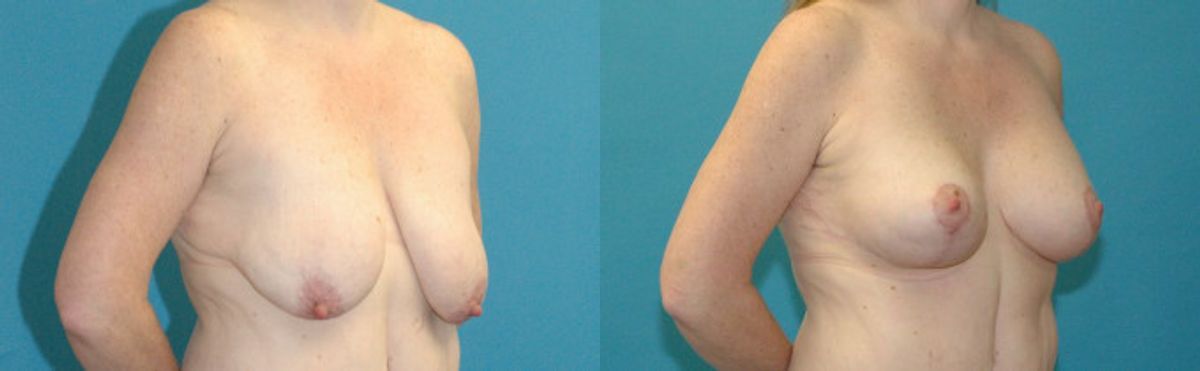 Breast Augmentation & Lift #31 - Before and After