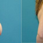 Breast Augmentation & Lift #31 - Before and After