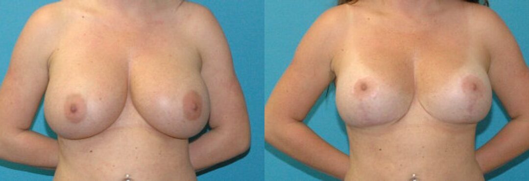 Breast Augmentation & Lift #32