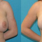 Breast Augmentation & Lift #32 - Before and After