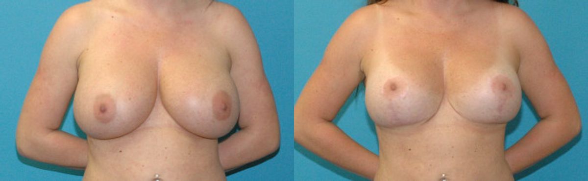 Breast Augmentation & Lift #32 - Before and After