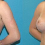 Breast Augmentation & Lift #32 - Before and After