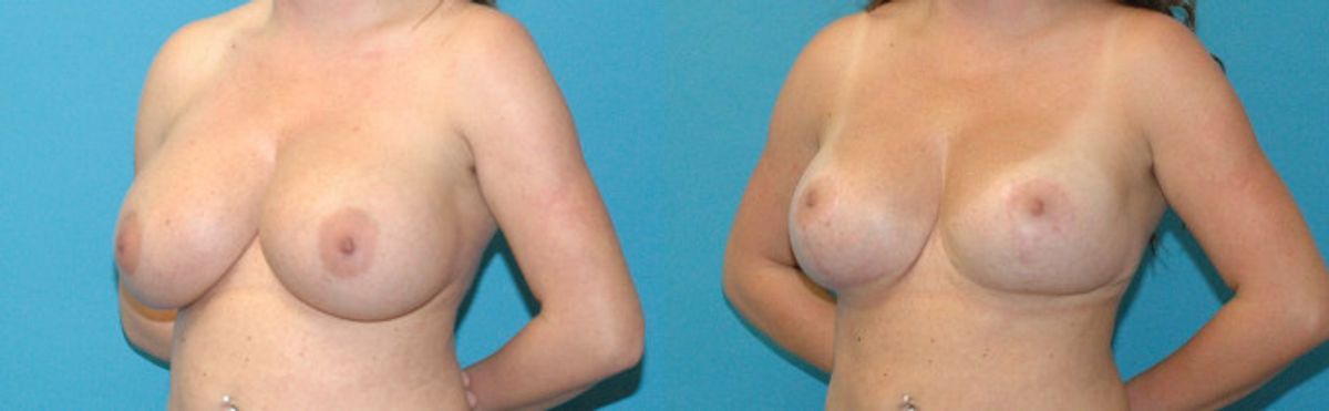 Breast Augmentation & Lift #32 - Before and After