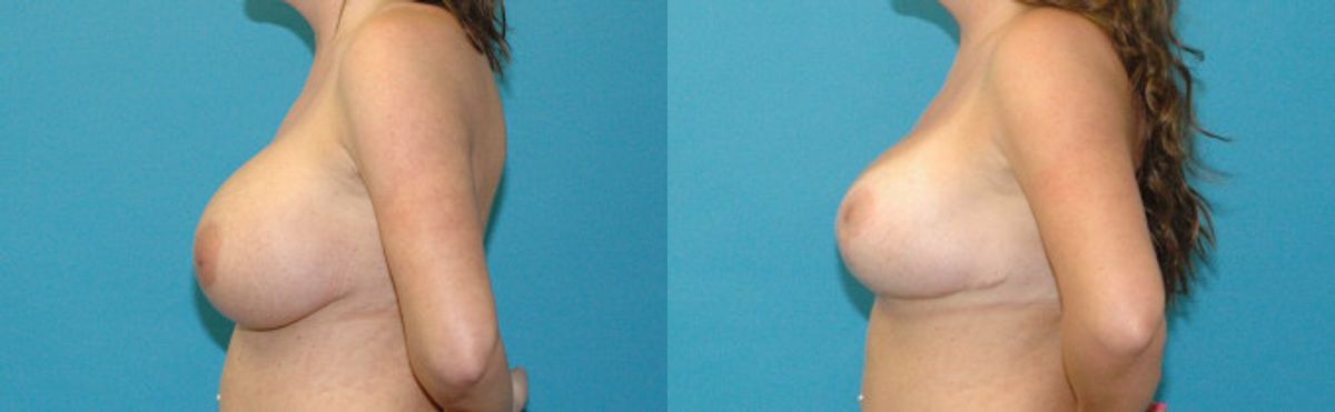 Breast Augmentation & Lift #32 - Before and After