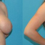 Breast Augmentation & Lift #32 - Before and After