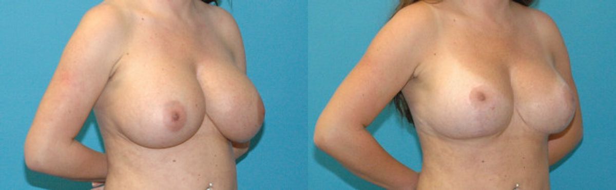 Breast Augmentation & Lift #32 - Before and After