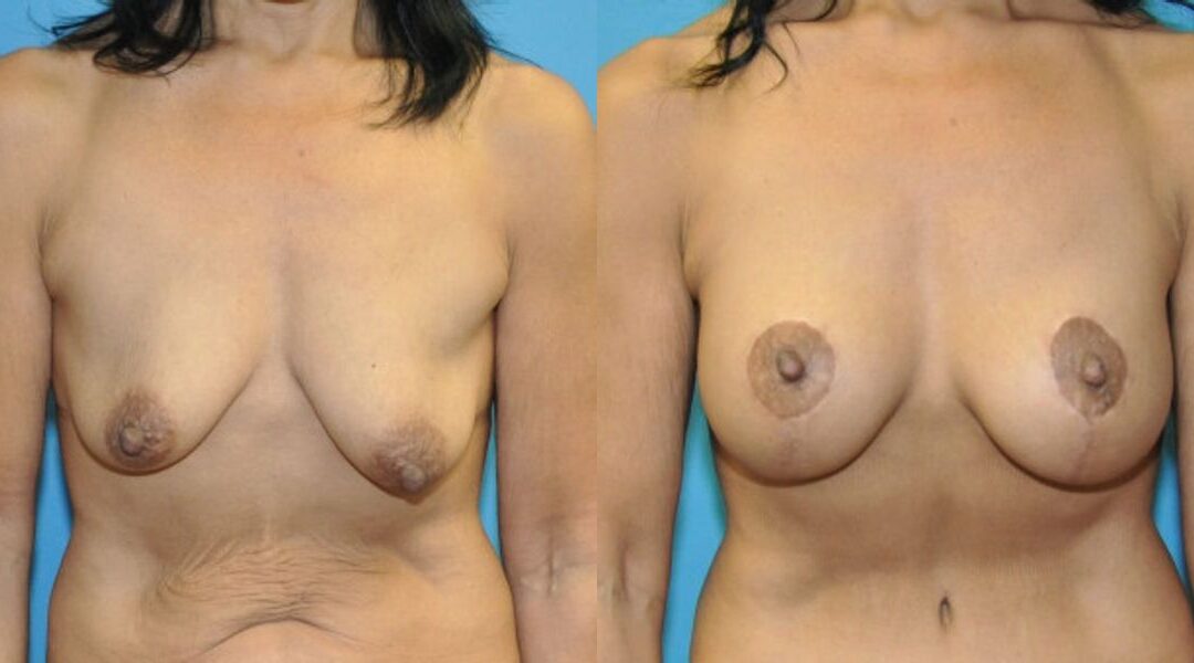 Breast Augmentation & Lift #33