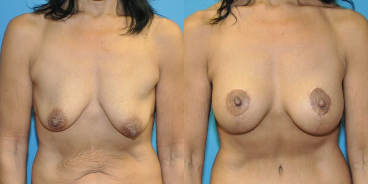 Breast Augmentation & Lift #33 - Before and After