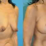Breast Augmentation & Lift #33 - Before and After